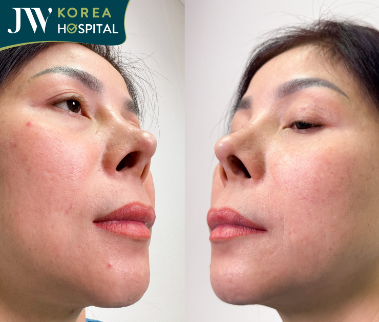 viêt kiều đài loan đến jw sửa mũi sau 5 lần nâng mũi co rút