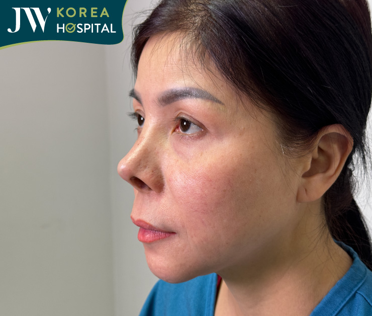 cận cảnh chiếc mũi hỏng sau 5 lần phẫu thuật của nữ việt kiều đài loan