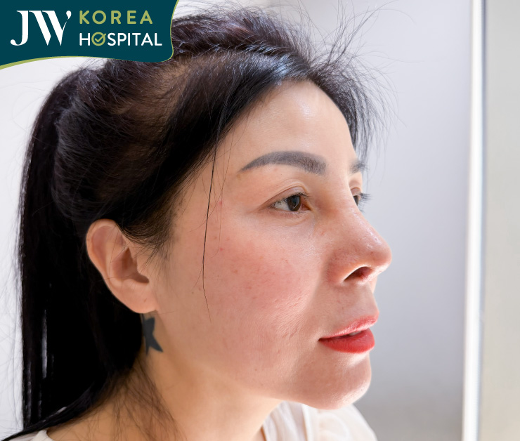 kết quả sau 7 ngày phẫu thuật tại jw