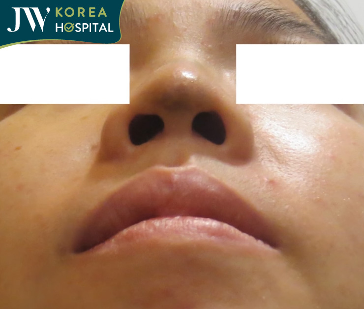 nữ việt kiều nâng mũi hỏng 5 lần minh họa