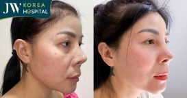 nữ khách hàng việt kiều đài loan hỏng mũi sau 5 lần phẫu thuật