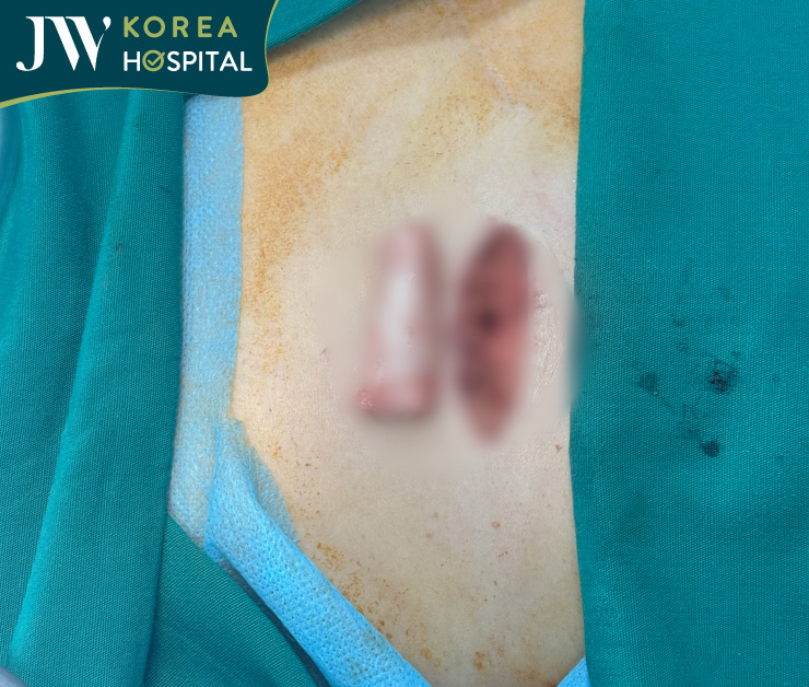 sụn sườn tự thân để nâng mũi s line sụn sườn