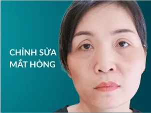 Chỉnh sửa mắt hỏng