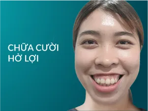 Chữa cười hở lợi