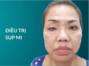 Điều trị sụp mí