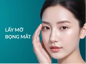 Lấy mỡ bọng mắt