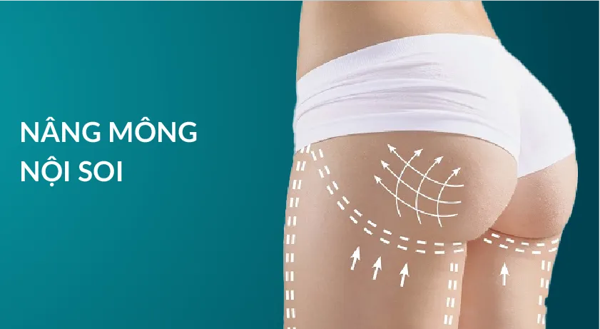 Nâng mông nội soi