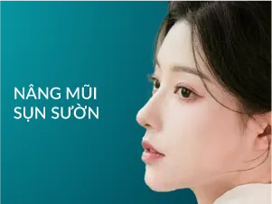 Nâng mũi sụn sườn