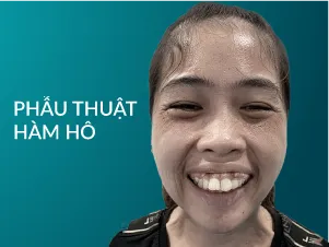 Phẫu thuật hàm hô