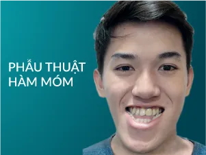 Phẫu thuật hàm móm
