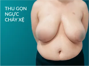 Thu gọn ngực chảy xệ