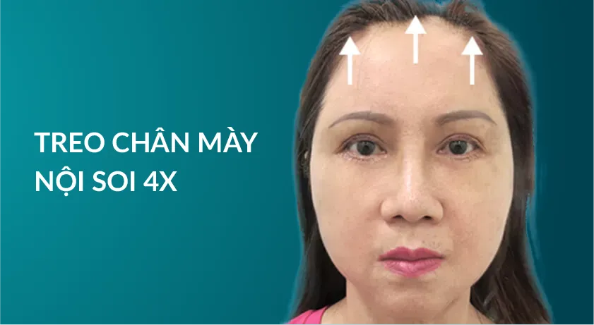 Treo chân mày nội soi 4x