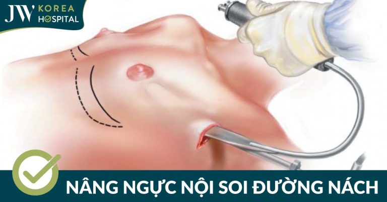 Nâng Ngực Nội Soi Đường Nách: Giải Pháp Quyến Rũ Không Sẹo