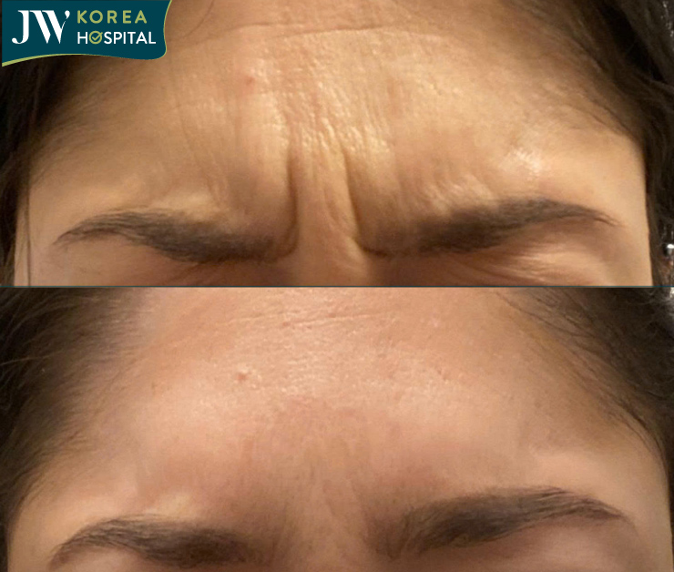 mesotox xóa nhăn khắc tinh của lão hóa thời hiện đại 2