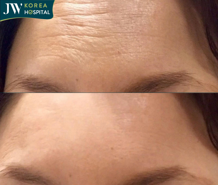 mesotox xóa nhăn khắc tinh của lão hóa thời hiện đại 3