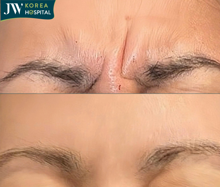 mesotox xóa nhăn khắc tinh của lão hóa thời hiện đại 1