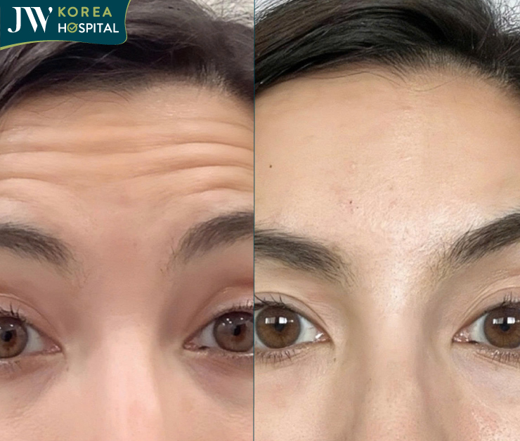 mesotox xóa nhăn trán khắc tinh của lão hóa thời hiện đại