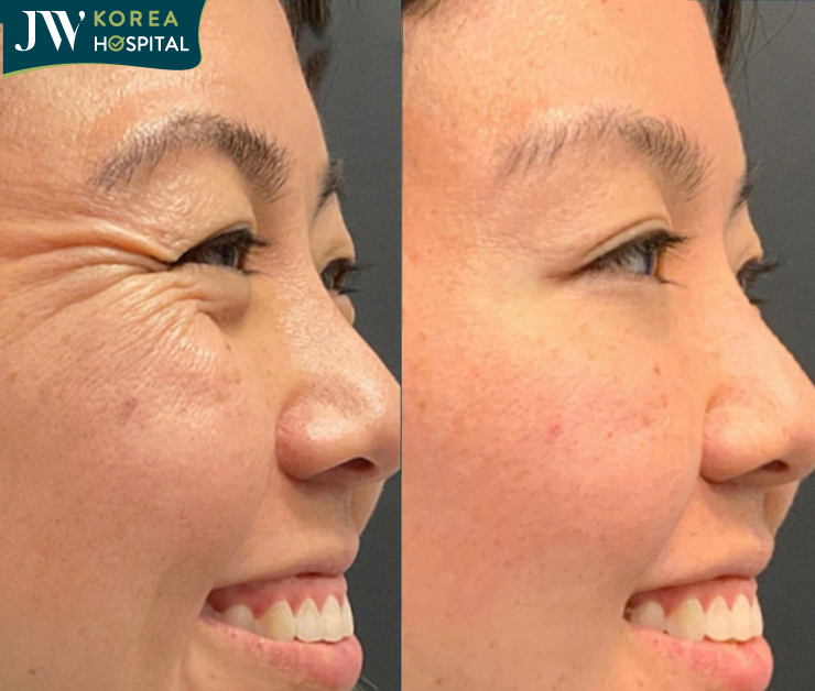 mesotox xóa nhăn khắc tinh của lão hóa thời hiện đại