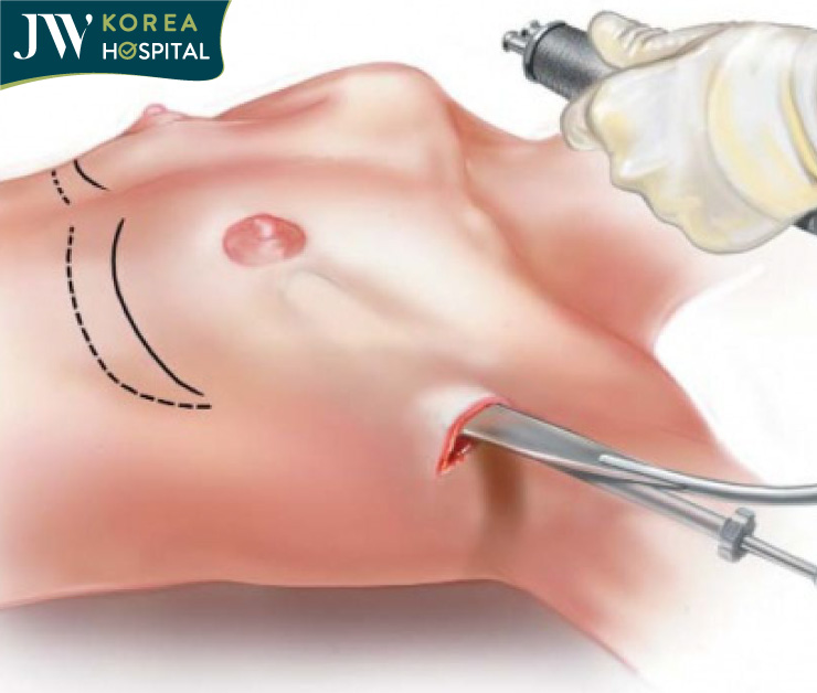 mô phỏng nâng ngực nội soi đường nách