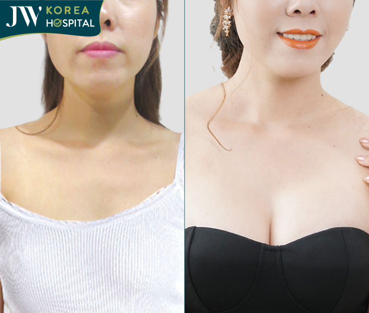 nâng ngực nội soi đường nách trước và sau khi nâng