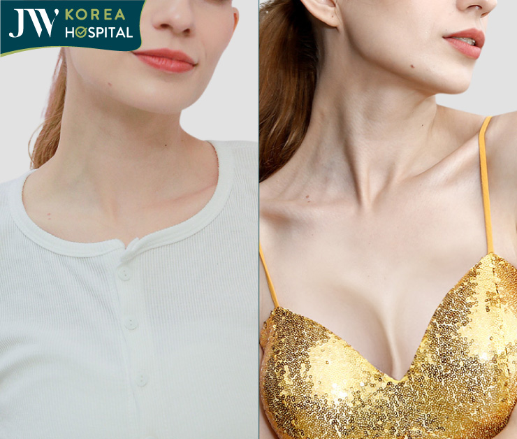 nâng ngực nội soi đường nách trước và sau khi nâng