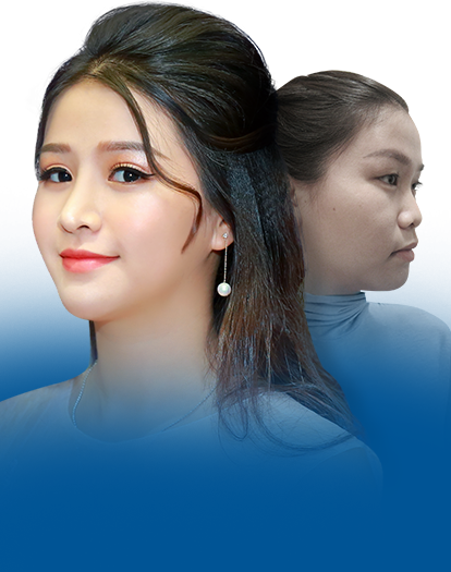 nâng mũi s line