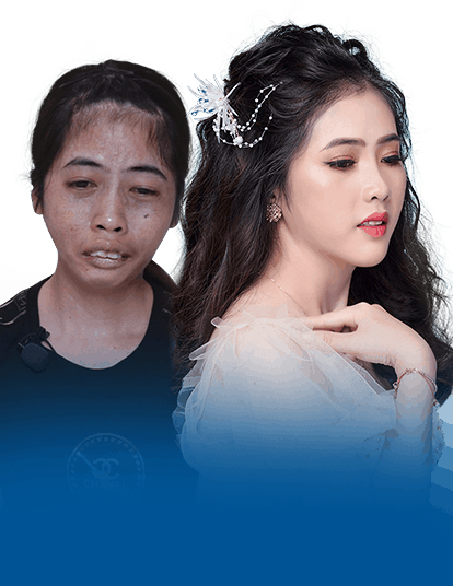 phẫu thuật hàm hô