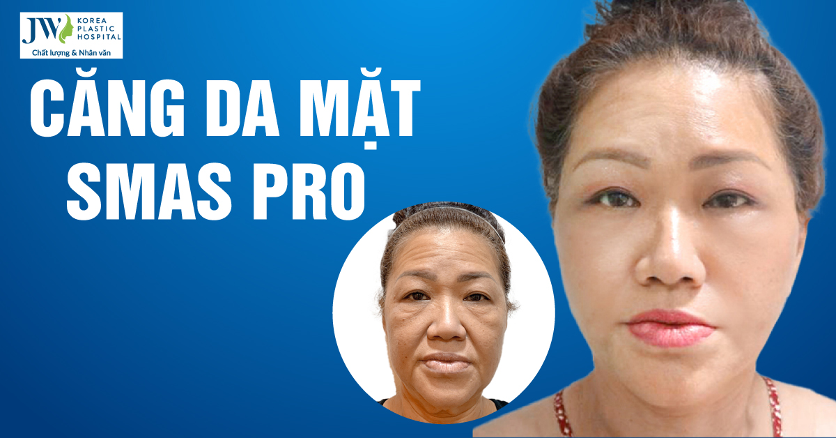 căng da mặt smas pro