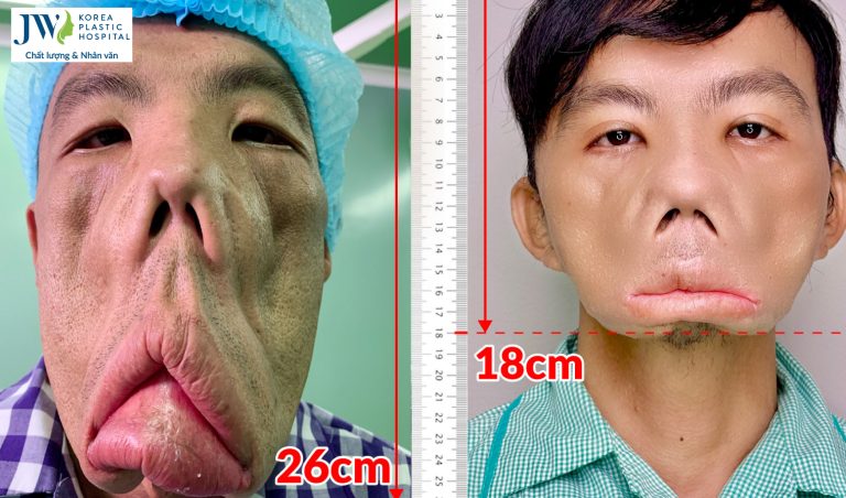 Hành trình 365 ngày thay đổi diện mạo của Anh Mến cùng Bác sĩ Tú Dung