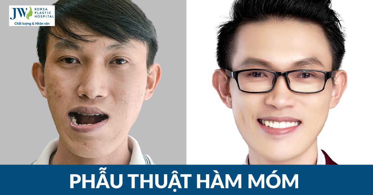phẫu thuật hàm móm