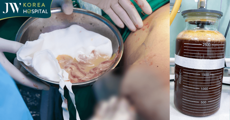 Ca đầu tiên tại Việt Nam nạo biến chứng filler bằng siêu âm AI