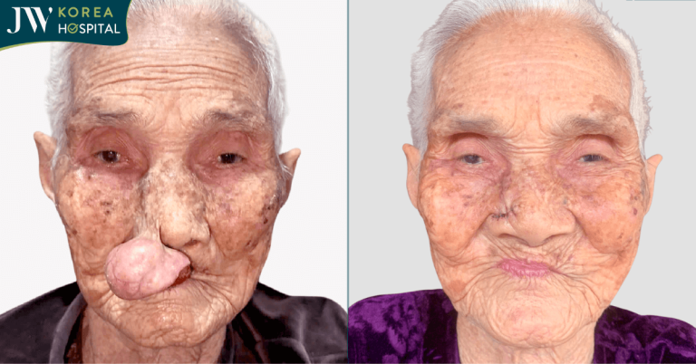 Hình ảnh mới nhất của cụ bà 100 tuổi sau khi được Bác sĩ Tú Dung cắt “bướu quỷ”