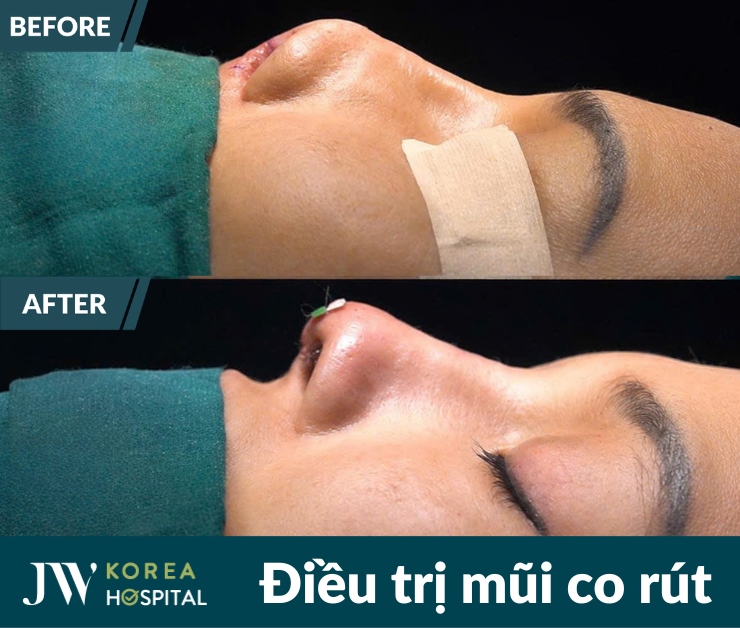 Nhiều trường hợp mũi co rút, biến dạng sau phẫu thuật được điều trị tại Bệnh viện JW.