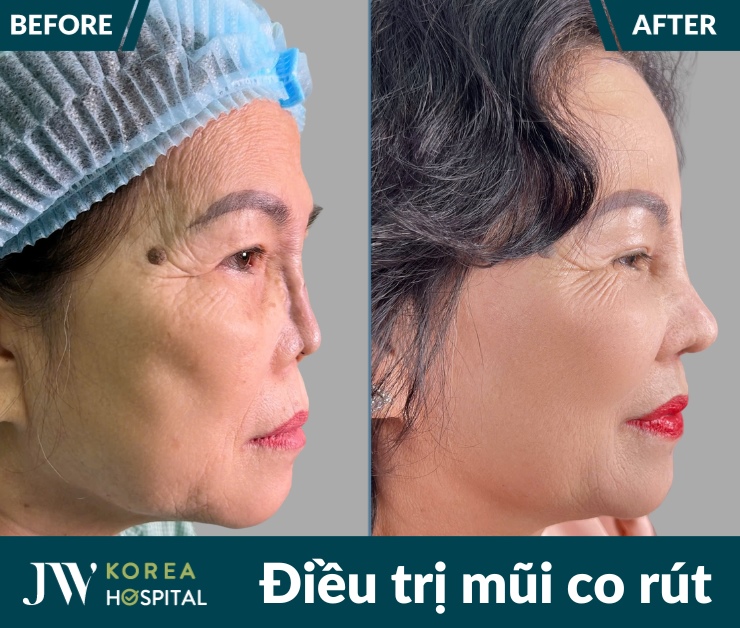 Bệnh viện JW tiếp nhận và điều trị thành công nhiều trường hợp mũi co rút, biến dạng sau phẫu thuật.