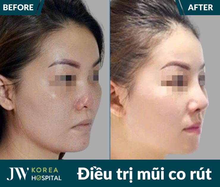 Bệnh viện JW tái tạo mũi co rút, biến dạng sau phẫu thuật thẩm mỹ không thành công